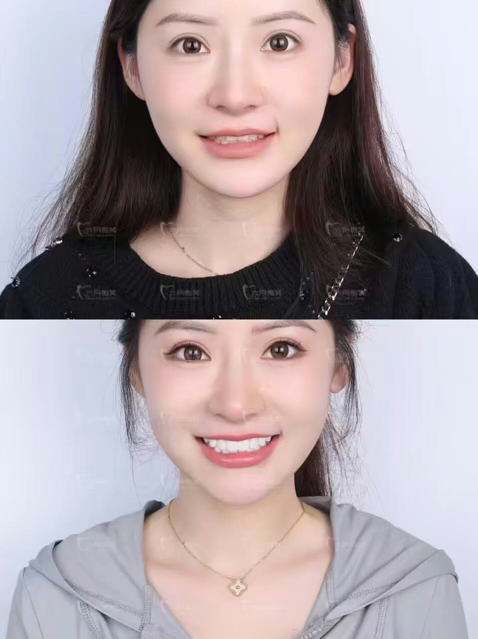 爱尔创瓷贴面授权图片 01