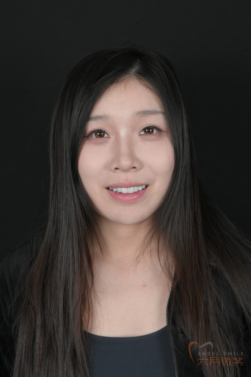 爱尔创瓷贴面授权案例