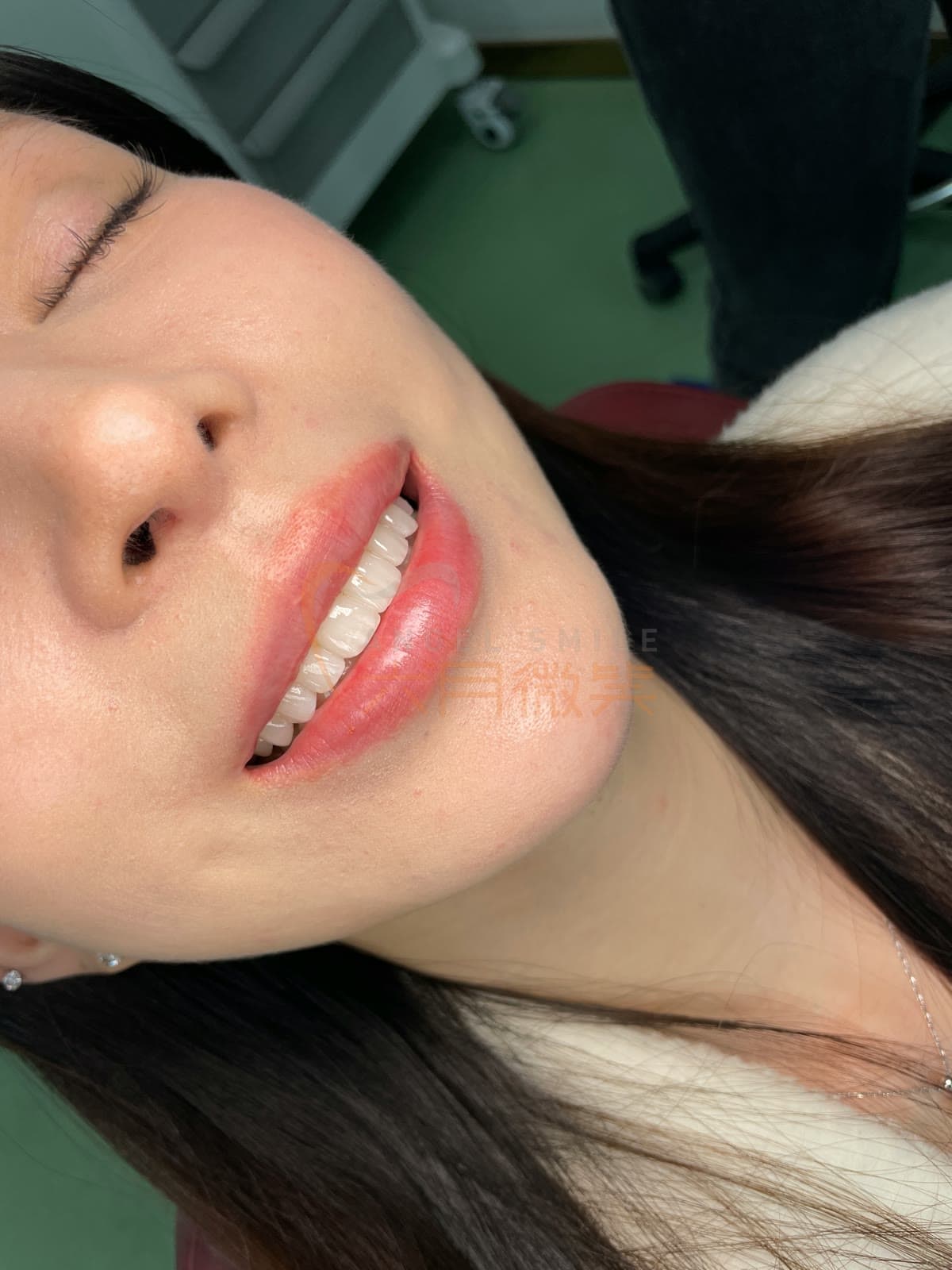 明星同款烤瓷贴面授权图片 02